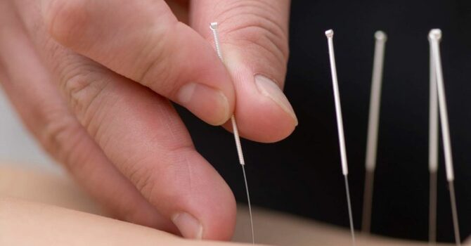 Taking Dry Needling to the Next Level image